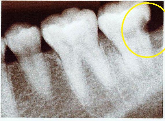 bone teeth