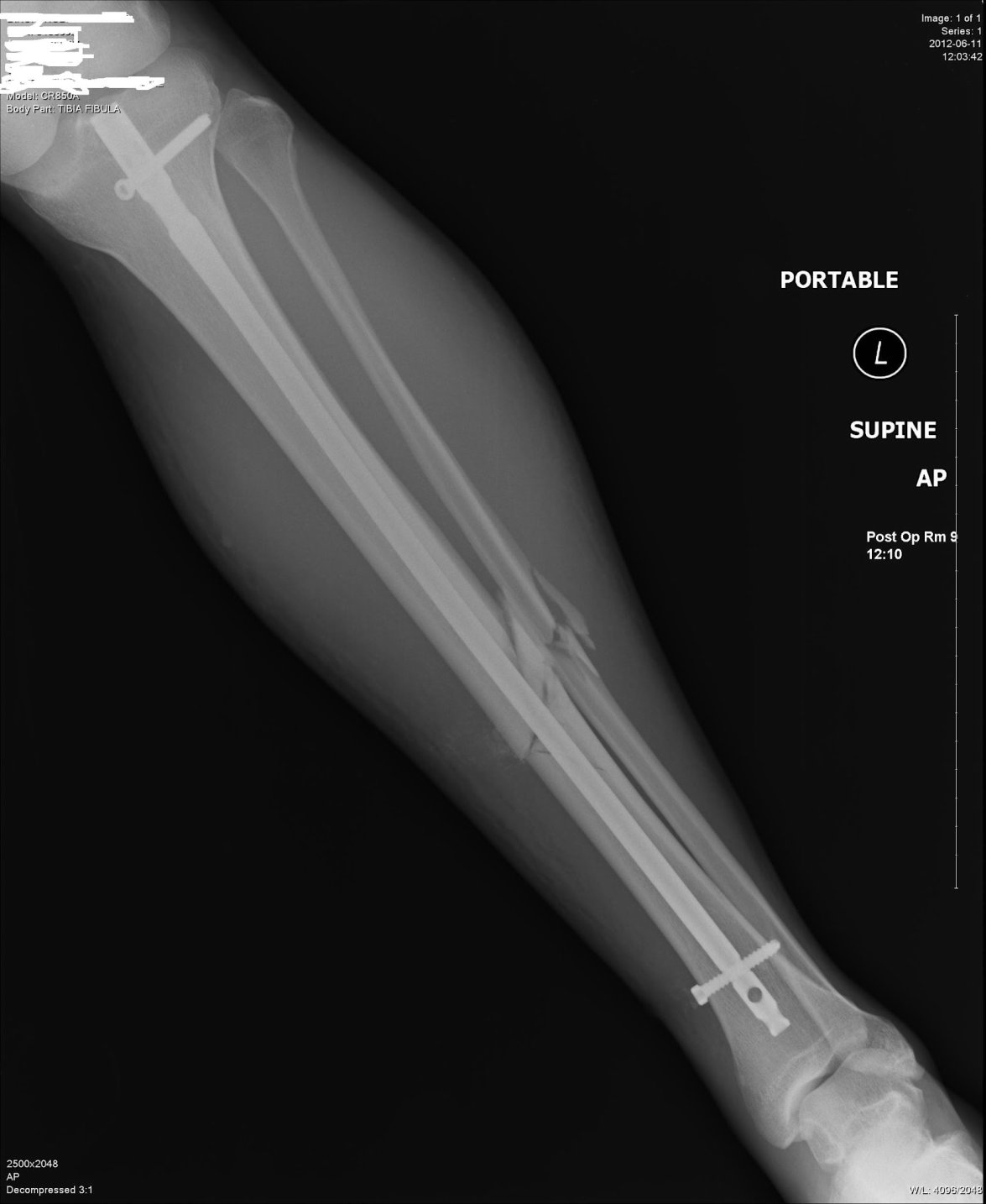 fibula bone fracture