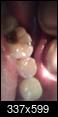 *Pics.. Bottom 2nd molar. What can be done to save this tooth.. Extraction/Root or Crown??-tooth.jpg
