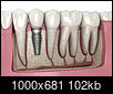 Can someone explain this dental plan?-dental-implant-illustration.jpg
