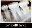 Dental issue: 00 for teeth extraction, bone graft, and implantation - reasonable?-teeth1.jpg