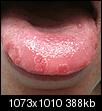 Sores in mouth, bumps on fingers (pics)-tongue.jpg