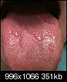 Sores in mouth, bumps on fingers (pics)-tongue2.jpg